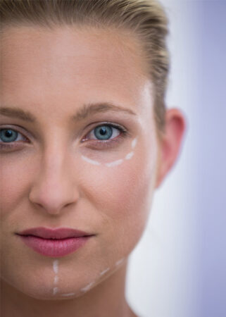 Close-up of woman with marks drawn for botox procedure